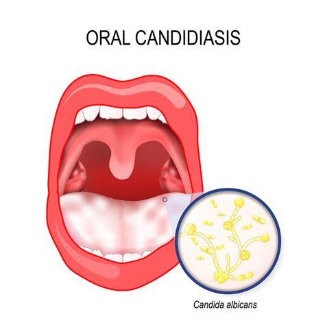 Oral Thrush: Causes, Symptoms, & Remedies | SmileKeepers