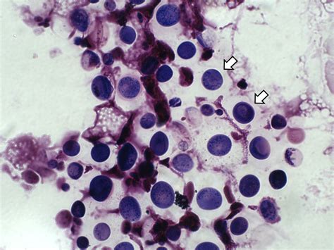 Cryptococcus Neoformans Gram Stain