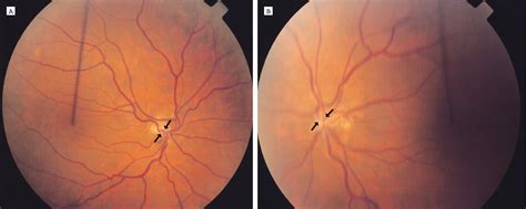 Progressive Visual Loss in Optic Nerve Hypoplasia and Bilateral Microdiscs | Neuro-ophthalmology ...