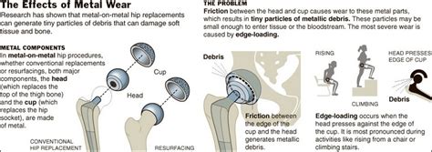 DePuy Orthopaedics Hip Implant Recalled Due to Metal Complications