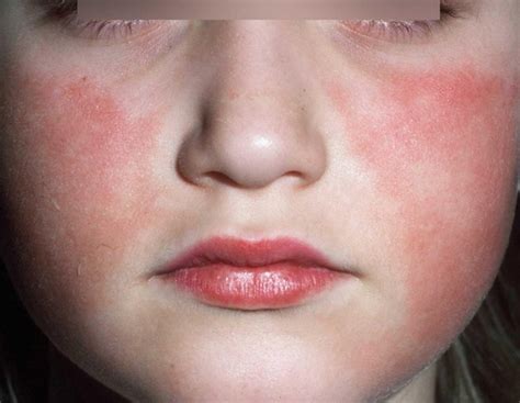 Maculopapular Rashes Causes (With Pictures)