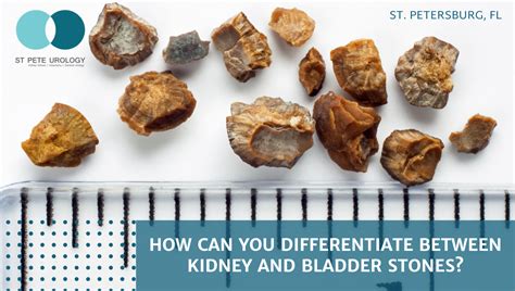 How Can You Differentiate Between Kidney and Bladder Stones? | St Pete Urology