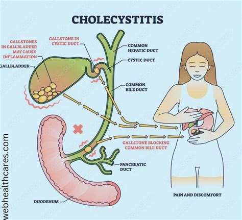 Acute cholecystitis :- About, Causes, Symptoms, Test, Treatment