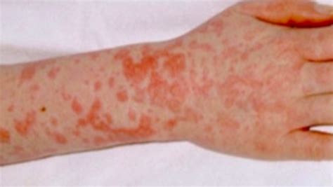 Scarlet Fever: Symptoms, treatment and advice | Central - ITV News