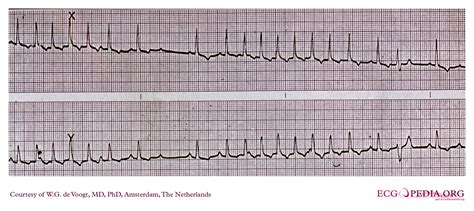 Atrial fibrillation with LBBB EKG examples - wikidoc