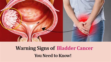 Bladder Cancer Warning Signs and Symptoms You Need to Know!