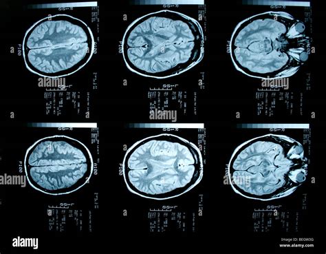 MRI scan of patient's brain with and without contrast agent Stock Photo - Alamy