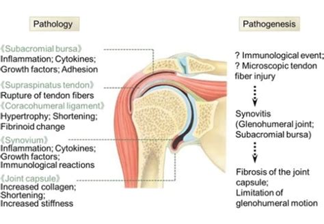 Frozen Shoulder - Allied Health Professionals