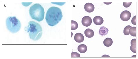 Laboratory diagnostics of HSCT complications: immature platelets and RBCs