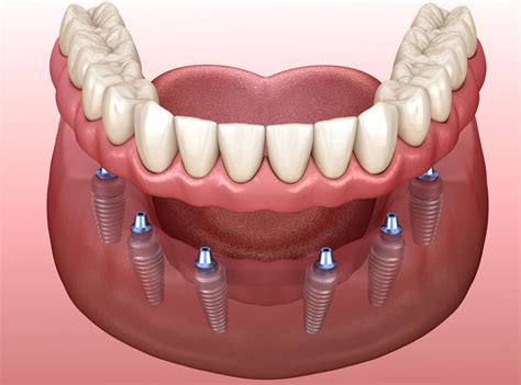 Implant Supported Dentures - integratedDENTAL - Woodbury, NY