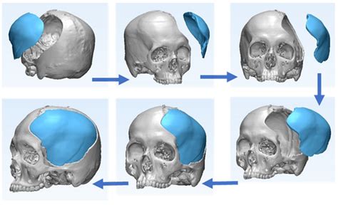 Applied Sciences | Free Full-Text | Cranial Implant Design Applying Shape-Based Interpolation ...