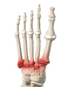 Midfoot Arthritis | Advanced Orthopaedics & Sports Medicine, Orthopaedic Specialists, Cypress ...