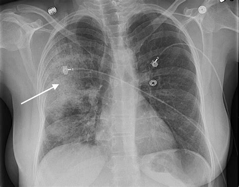 Cureus | Community-acquired Pneumonia with Methicillin-resistant Staphylococcus Aureus in a ...