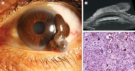 Conjunctival Melanoma | External Eye Disease | JAMA Ophthalmology ...