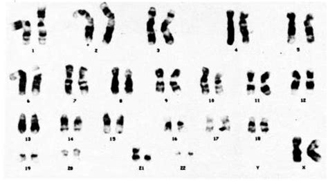 Translocation Down Syndrome Diagram