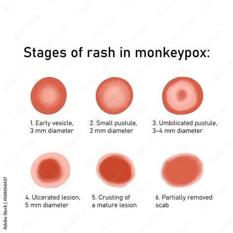 Stages of rash in monkey pox. Monkeypox virus zoonotic viral disease that can infect human ...