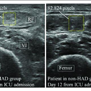 Comparison of the longitudinal change of muscle echogenicity and phase... | Download Scientific ...