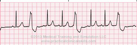 Sinus rhythm with pvc 240418-Sinus rhythm with pvc ecg strip