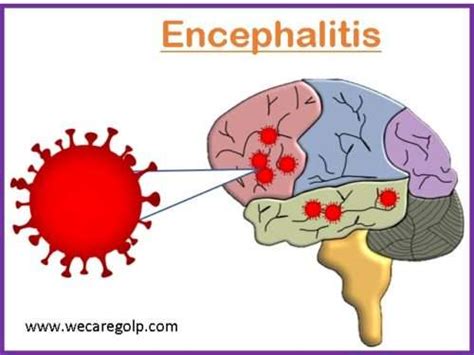 Encephalitis: Causes, Treatment, Prevention - We Care