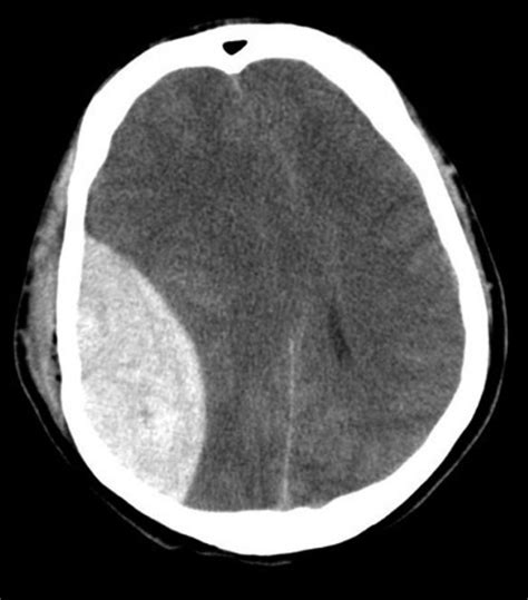 Axial noncontrast CT scan of the brain, right-sided epidural... | Download Scientific Diagram