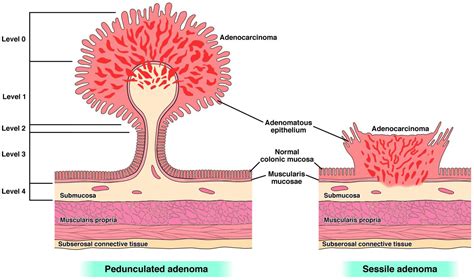 Experts release new management strategies for malignant colorectal polyps – VectorsJournal