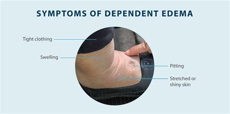 Dependent Edema: Symptoms, Causes, Treatment & More - Tactile Medical