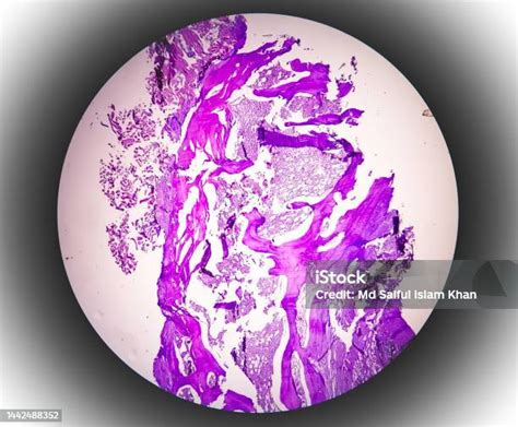 Microscopic Examination Of Thyroglossal Duct Cyst Persistent ...