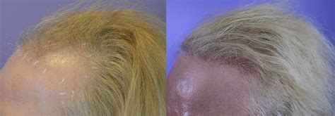 Female Hairline Restoration - Hair Restoration of the South