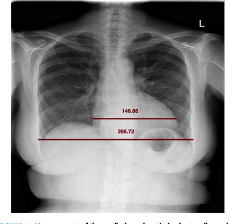 How To Detect Cardiomegaly On Chest X Ray at Betty Beaton blog