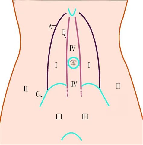 Extraperitoneal space in abdominal wall. | Download Scientific Diagram