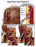 Right Chest Tube Placement - R15607_02XG