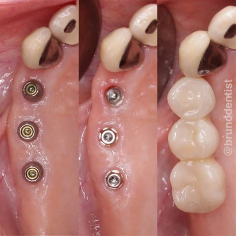 Screw retained bridge made on micro abutments. #dentalimplants #dentalimplantbridge # ...