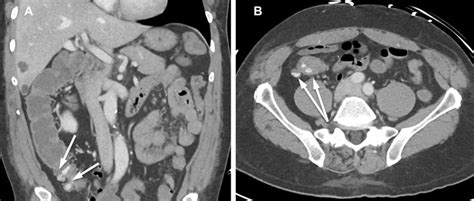 Colonic diverticular bleed (arrows) in the coronal (A) and axial (B ...