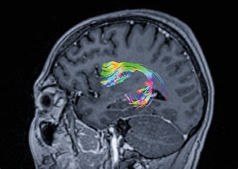 Arcuate Fasciculus connecting Broca's and Wernicke's areas | Download ...