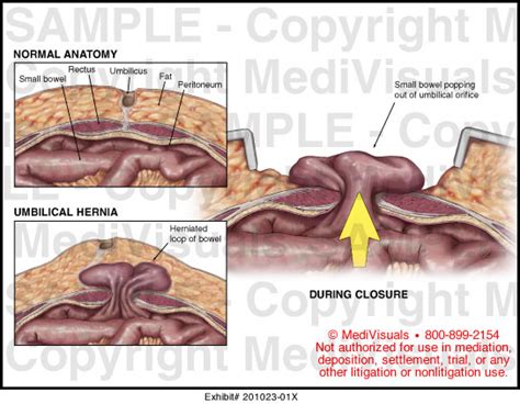 Umbilical Hernia Medical Illustration Medivisuals