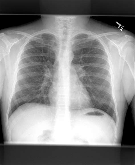 Difficult-to-control asthma in 13-year-old boy