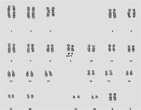 The karyotype of pericentric inversions on the both chromosomes 9 in ...