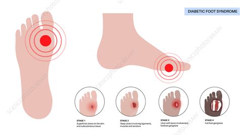 Diabetic foot ulcers, illustration - Stock Image - F042/1343 - Science ...