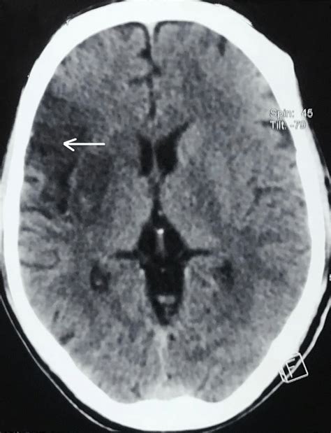 A computed tomography (CT) scan of the head showed right-sided ischemic ...