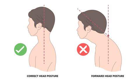 How To Correct Forward Neck Posture, AKA Nerd Neck – Posture Pro, Inc.