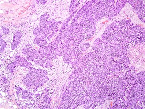 Nasopharyngeal Carcinoma Histology