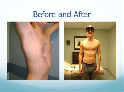 Before & After - Center of Excellence for Pectus