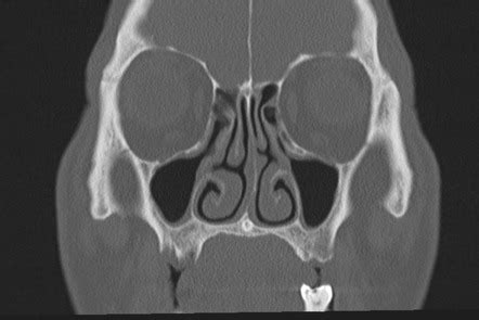 Ct Stryker Protocol - sumostory