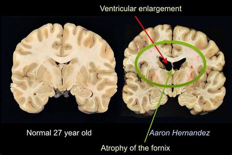 UB psychiatry resident explores link between brain injuries, suicide - UBNow: News and views for ...