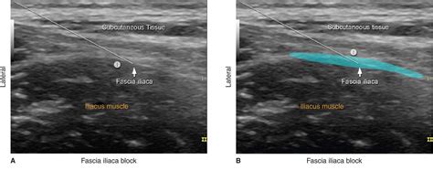 Fascia Iliaca Femoral Nerve Block