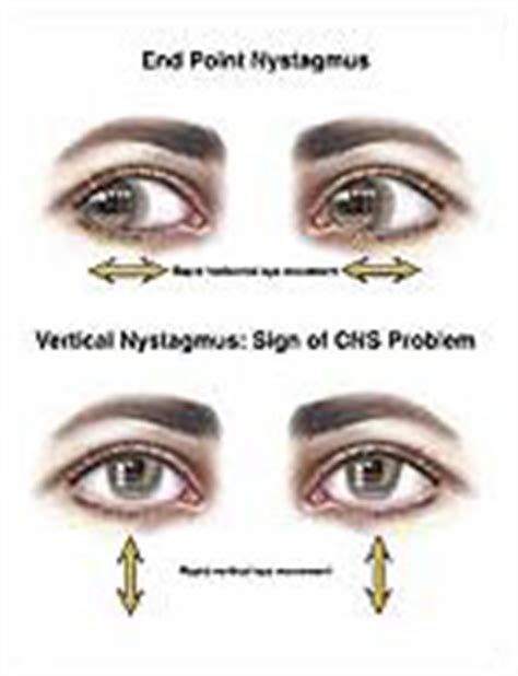 Medivisuals Nystagmus Medical Illustration