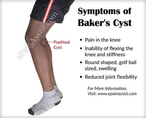 Baker's Cyst or Popliteal Cyst|Causes|Symptoms|Treatment|Exercise|Home ...