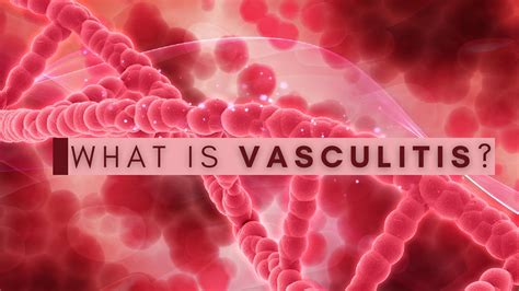 What Is Vasculitis? Know About The Causes, Types, Symptoms And Treatment - Boldsky.com