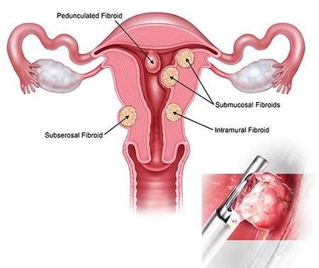 Myosure Fibroid and Polyp Removal Procedure - Women's Health Specialists