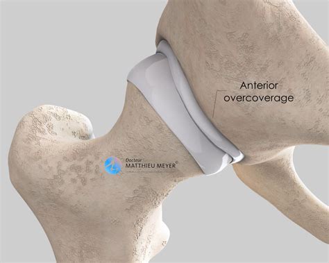 Anterior Hip Impingement Arthroscopy - Doctor Matthieu Meyer